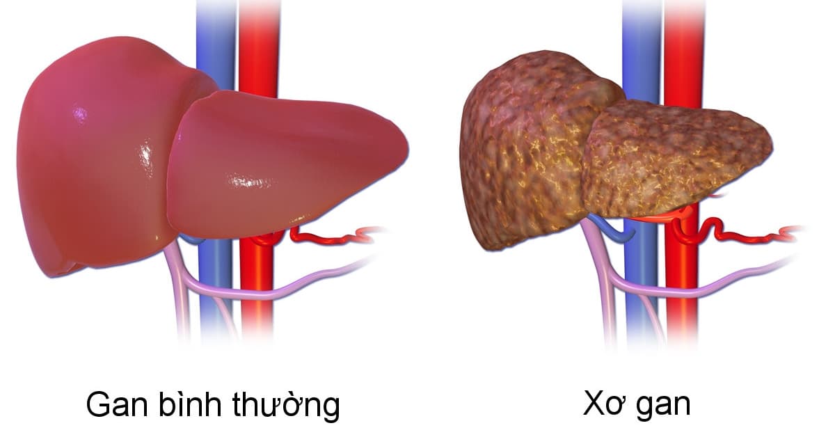 Siêu âm gan nhu mô không đều là bệnh gì, cách điều trị thế nào?
