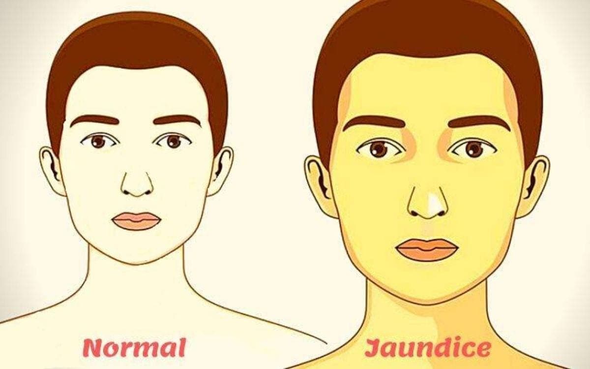 Bệnh nhân vàng da cần lưu ý chế độ ăn như thế nào