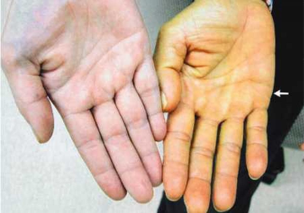 Gan tốt hay không, nhìn sắc mặt là biết! Hai thay đổi nhỏ trên mặt là dấu hiệu ung thư gan và xơ gan, soi gương có thể phát hiện
