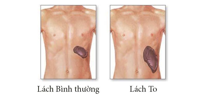 Không phải ai lách to cũng bị xơ gan, tại sao xơ gan lại gây lách to?