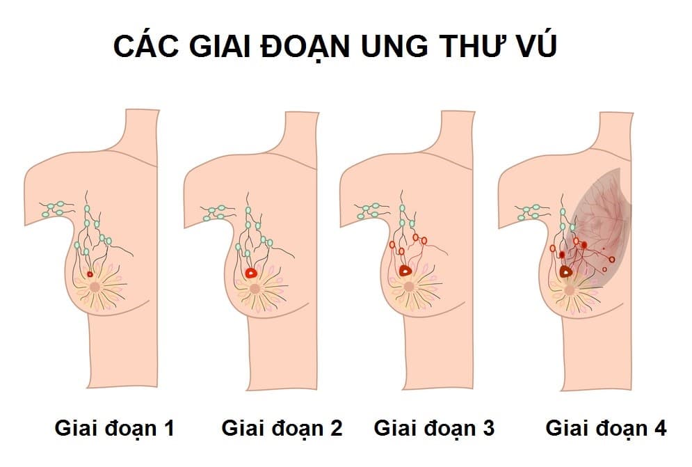 20 kiến ​​thức cần thiết cho bệnh nhân ung thư vú, đơn giản và thiết thực!