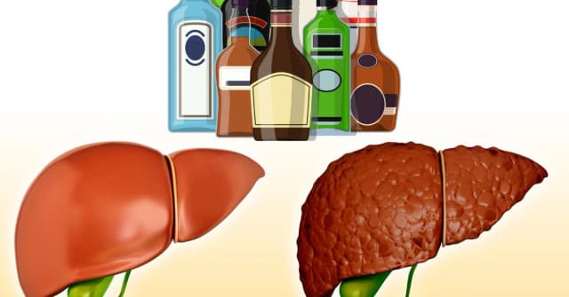 Rượu gây xơ gan như thế nào? Hiểu đúng ba bước phá gan