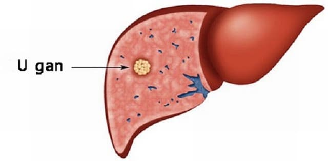 U gan hiếm ở người lớn: tái phát sau 8 năm